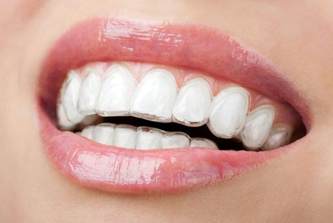 ¿Qué es la ortodoncia invisible o invisaling?