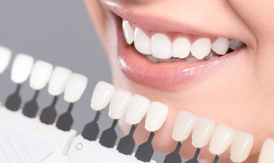 ¿Conoces los detalles de un blanqueamiento dental y sus tipos?