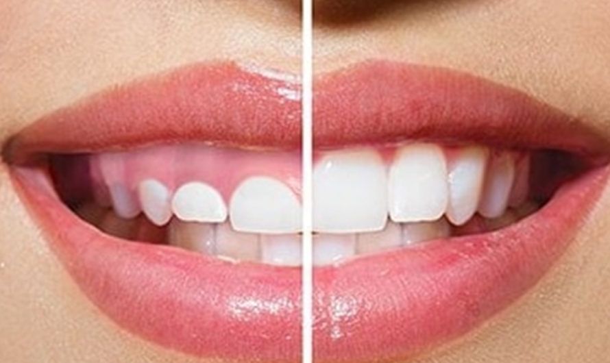 ¿Conoces las ventajas de la gingivectomía?