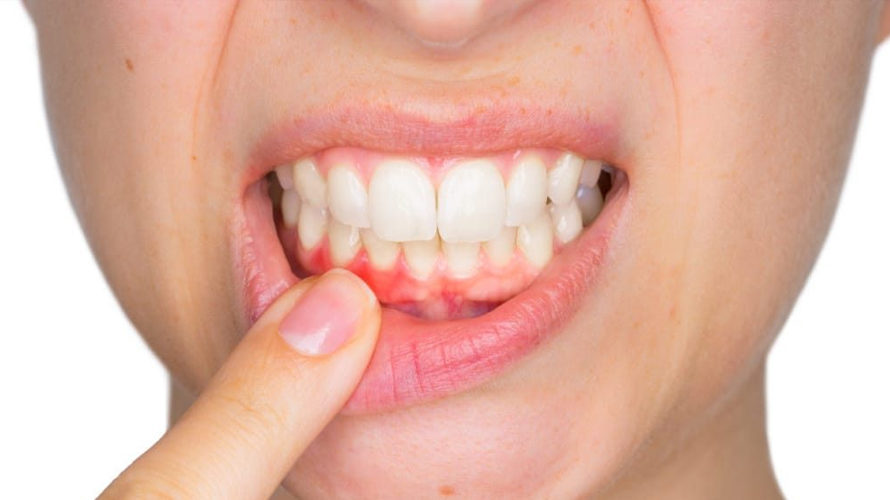 ¿Cómo tratar el sangrado de encías en la periodoncia?