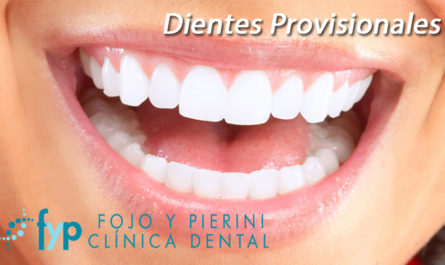 dientes provisionales