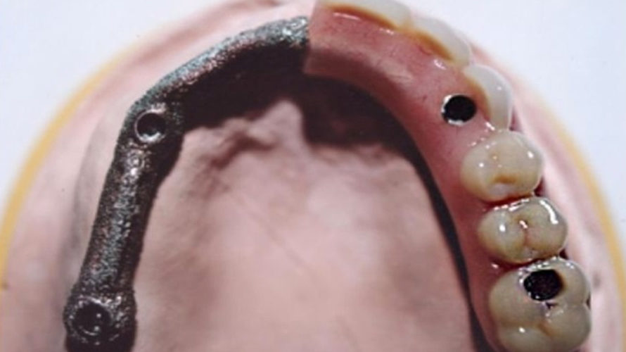 ¿Qué es una prótesis híbrida sobre un implante?