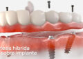 protesis hibridas implantes
