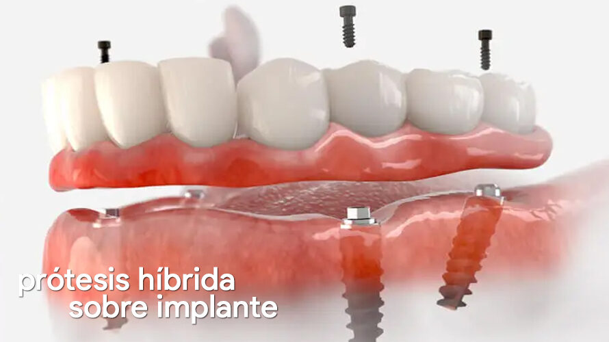 ¿Qué es una prótesis híbrida sobre implante?