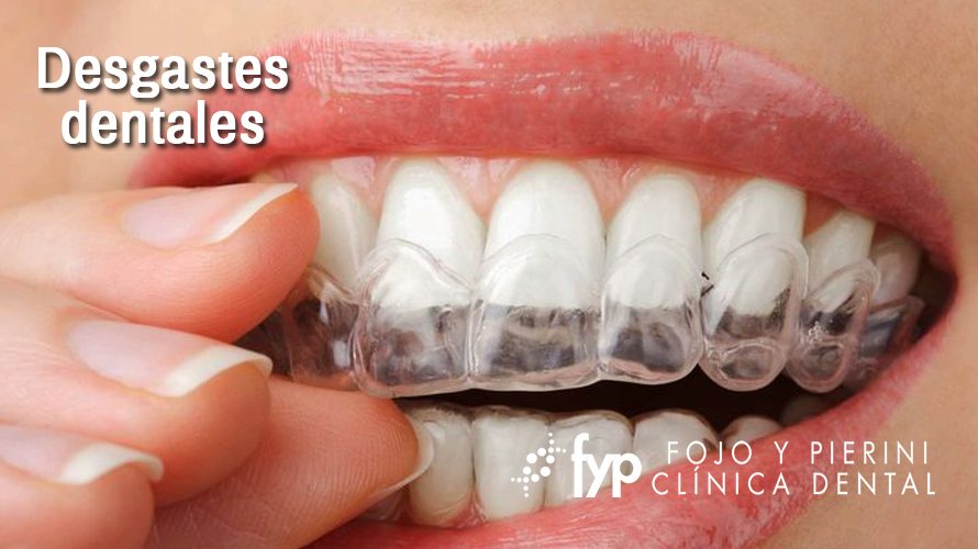 Entendiendo los tipos de desgastes dentalesy cómo manejarlos