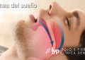 apnea del sueño