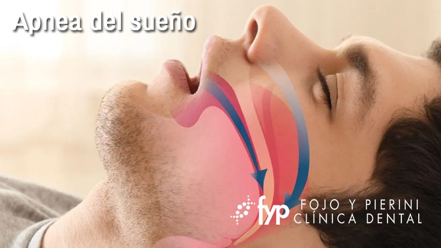 Tratamiento y diagnóstico de la apnea del sueño con dispositivos de avance mandibular