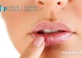 herpes labial