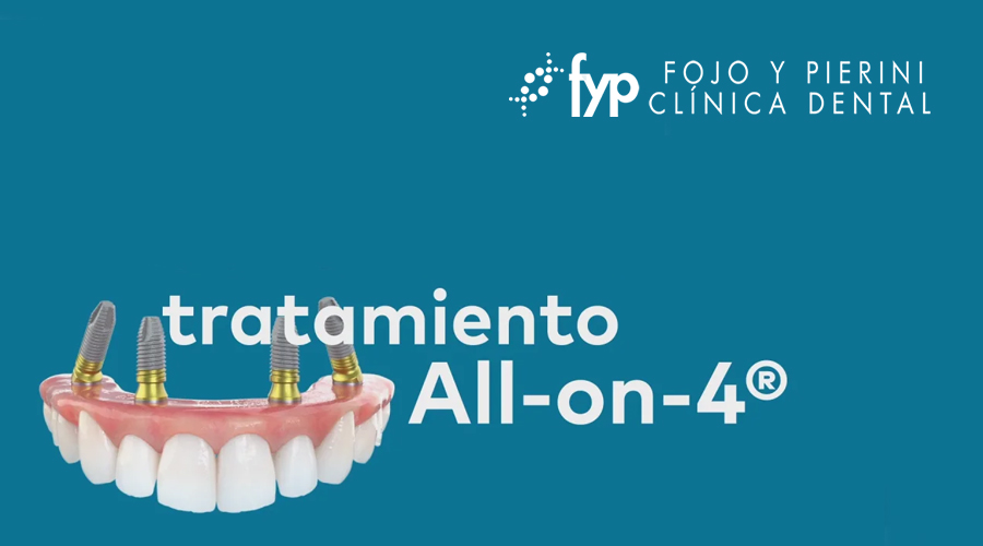 La técnica All-On-4® es un tratamiento revolucionario diseñado para pacientes que han perdido todos los dientes de una arcada (superior o inferior) o presentan una dentición muy deteriorada.