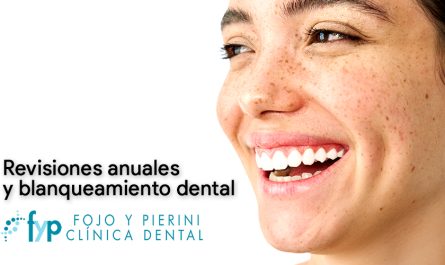 revision y blanqueo dental